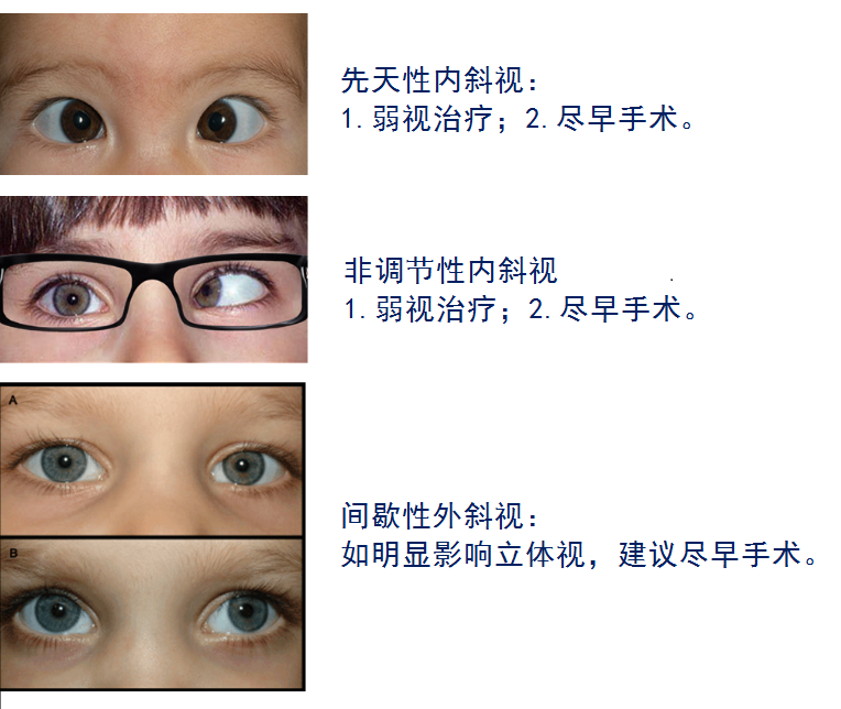 斜视手术能拖吗?孩子太小,能不能晚点手术?